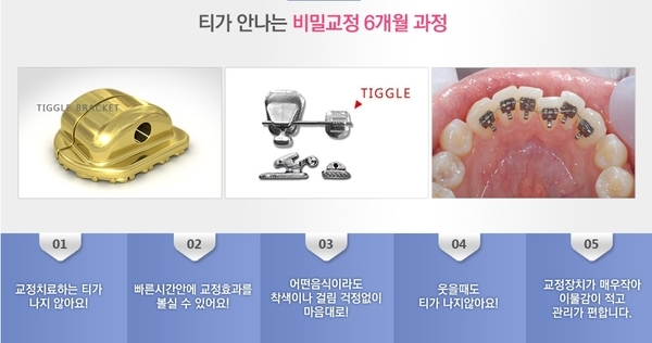 치아교정 6개월에 완성할 수 있어요! 2